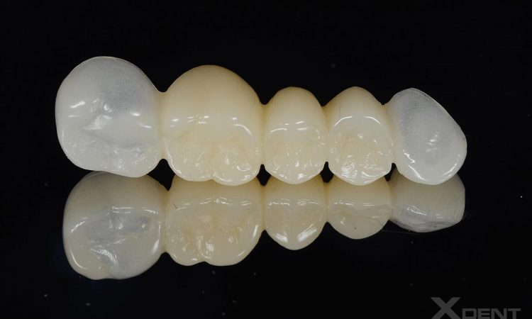 PMMA Temporary crowns