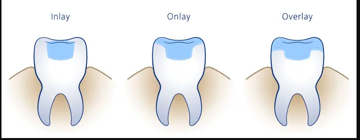 WHAT ARE DENTAL FILLING, INLAY, ONLAY, AND OVERLAY?