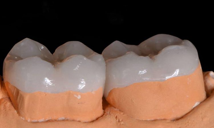 THE DENTAL OVERLAY-2 MINS OF QUICK LEARNING