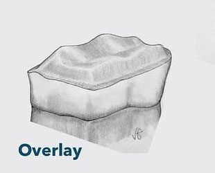 Dental Overlay