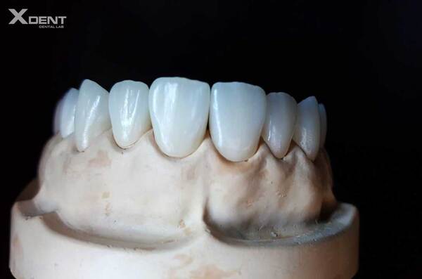 EMAX CROWN: THE BEST TRANSLUCENT DENTAL MATERIAL