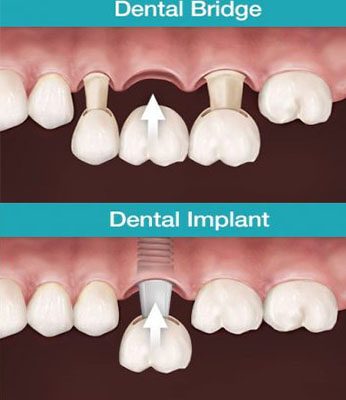 comparison-of-dentak-bridges-and-implants