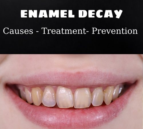 Enamel decay:  Causes,  Treatment and Prevention