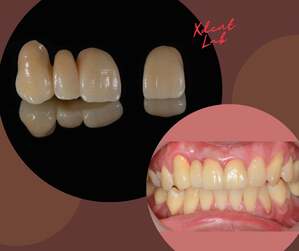 Aesthetic porcelain teeth